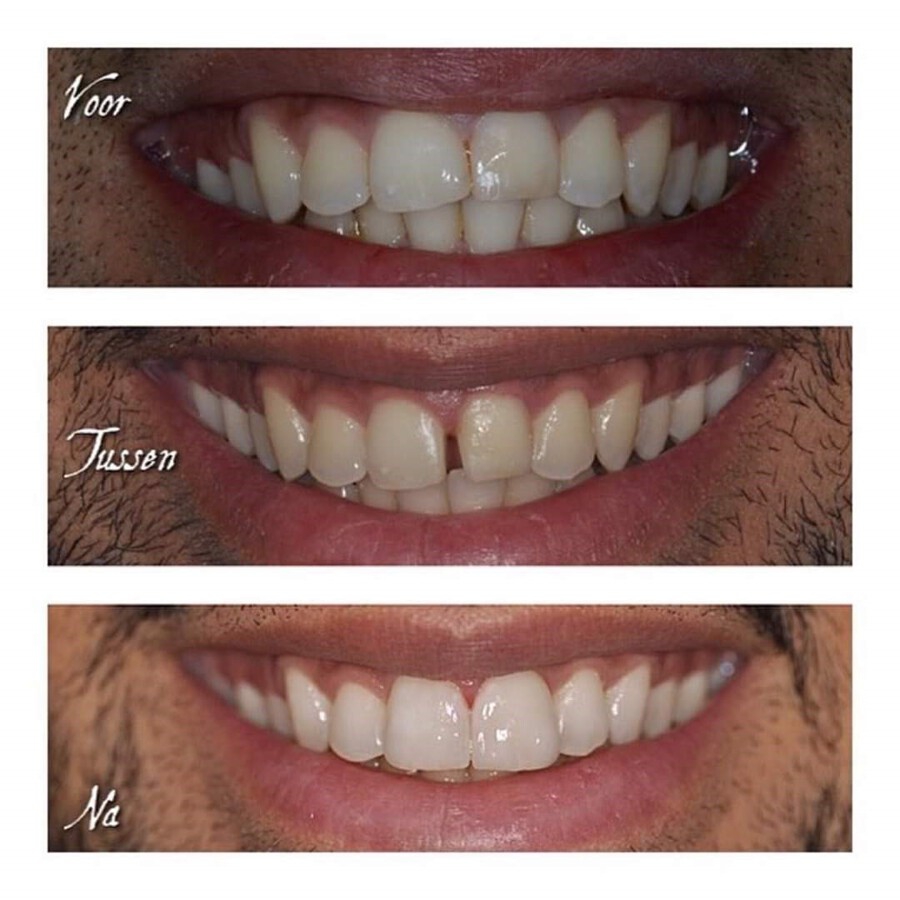 Facings op twee front tanden